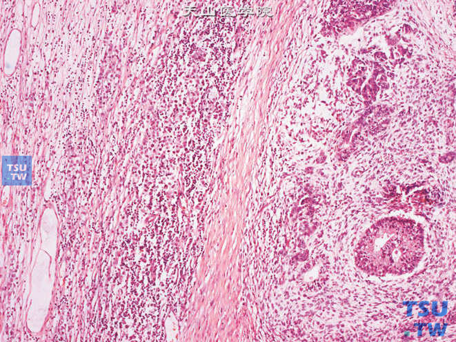睾丸混合性生殖细胞肿瘤，畸胎瘤+胚胎性癌+精原细胞瘤。高倍镜示精原细胞瘤（左）及胚胎性癌（右）成分