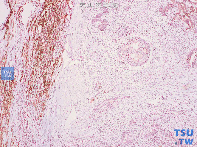 睾丸混合性生殖细胞肿瘤，胚胎性癌（中间偏右）免疫组化：PLAP（弱+），精原细胞瘤（左）免疫组化：PLAP（+）