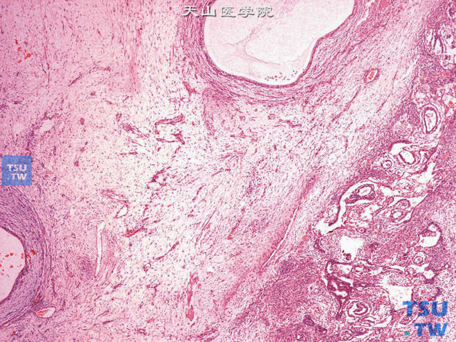 睾丸混合性生殖细胞肿瘤，卵黄囊瘤（右下）+畸胎瘤（左中上）