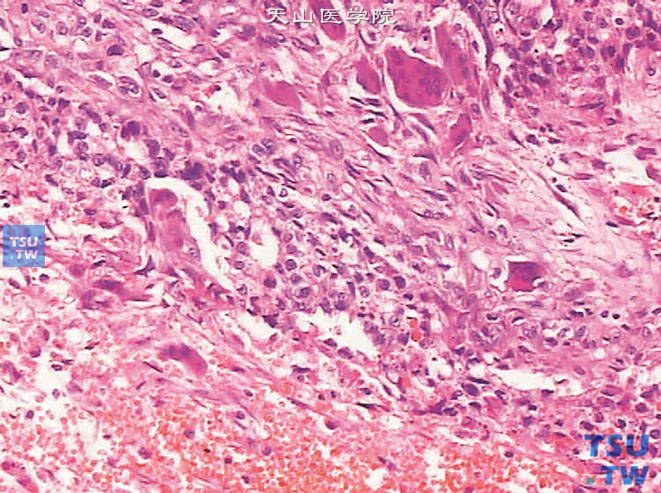 睾丸混合性生殖细胞肿瘤，示滋养叶细胞及出血