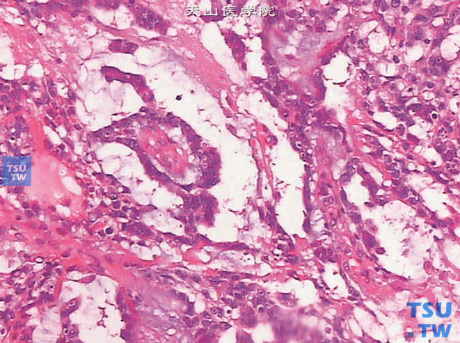 睾丸混合性生殖细胞肿瘤，示其中的内胚窦样结构