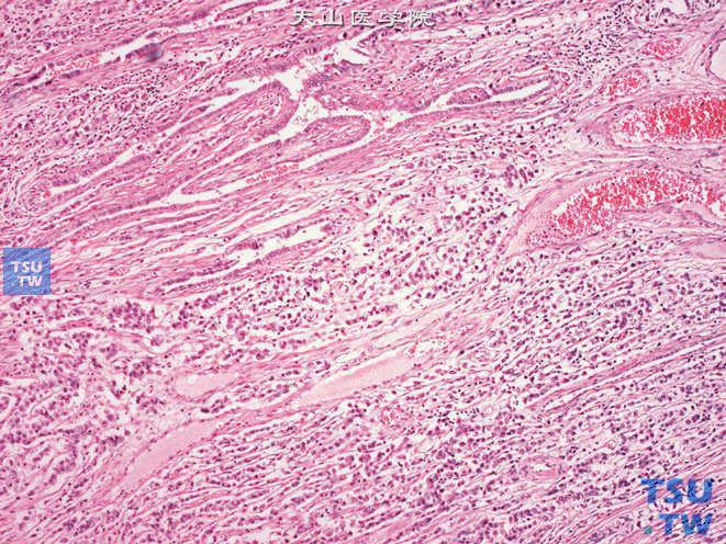 睾丸混合性生殖细胞肿瘤，示肿瘤成分侵犯睾丸网