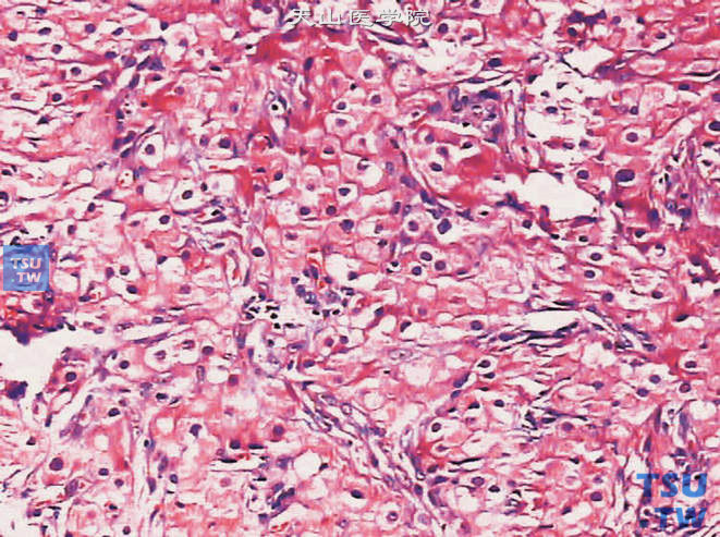 睾丸间质细胞瘤，示肿瘤呈实性片状结构