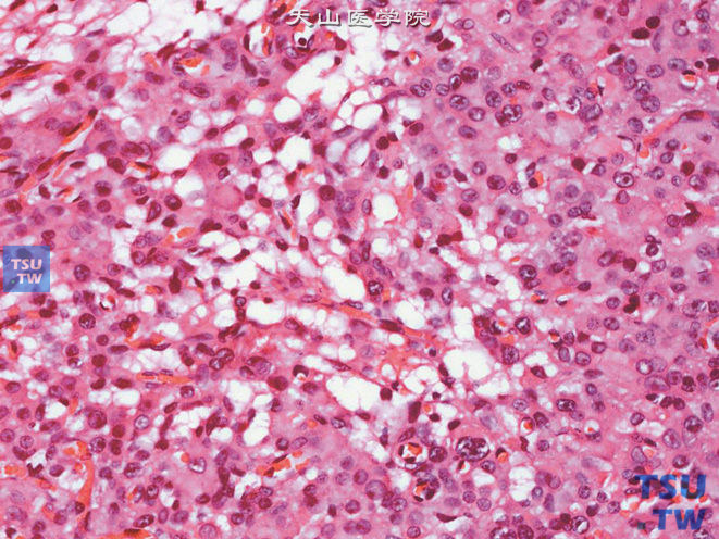 睾丸间质细胞瘤，示部分胞质呈空泡状