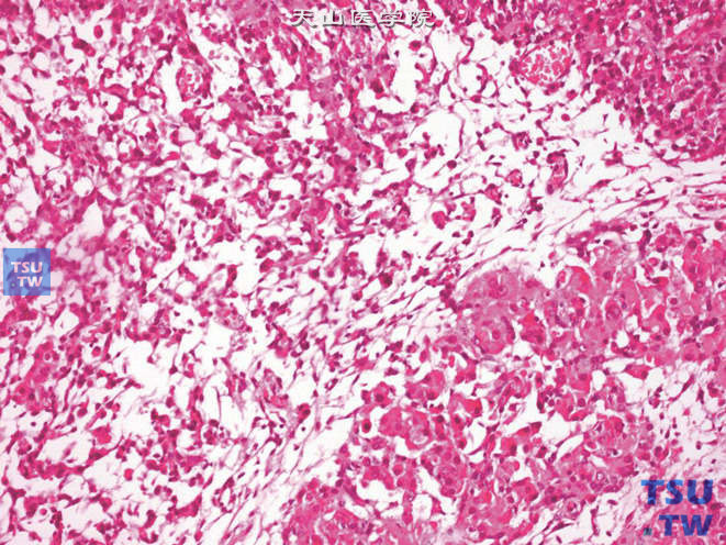 睾丸间质细胞瘤，可见不常见的微囊改变