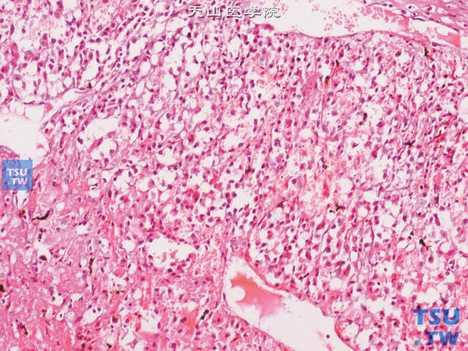 睾丸间质细胞瘤，不常见的微囊状结构
