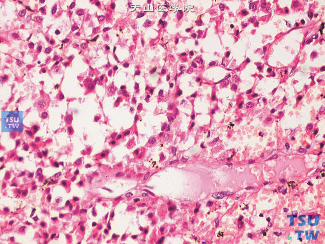 睾丸间质细胞瘤，不常见的微囊状结构，上图高倍