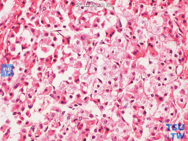 睾丸间质细胞瘤，示富于脂质的胞质