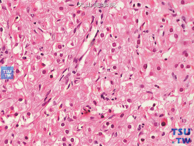 睾丸间质细胞瘤，部分瘤细胞胞质呈空泡状