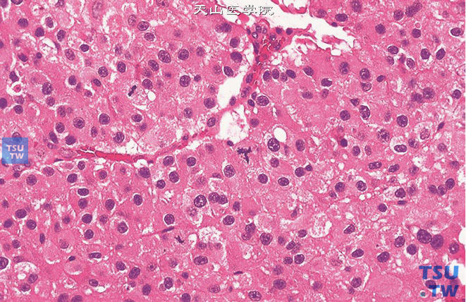 睾丸恶性间质细胞瘤，细胞异型性明显，每10个高倍视野大于3个核分裂象