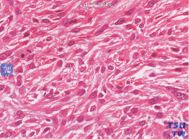 睾丸恶性间质细胞瘤，肿瘤细胞呈条索状排列，核分裂象多见