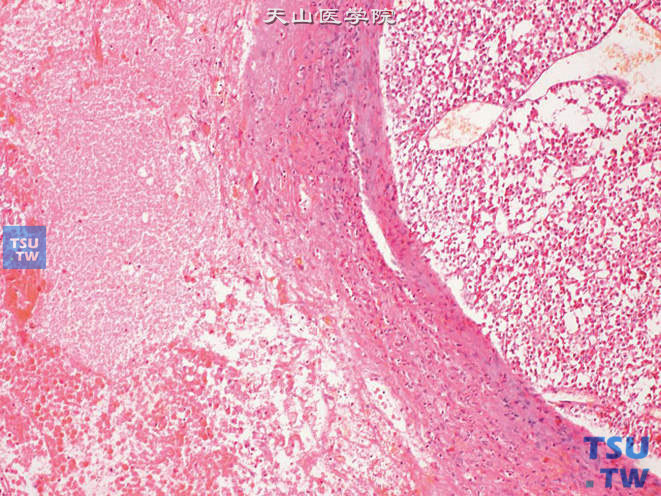 睾丸恶性间质细胞瘤，可见坏死