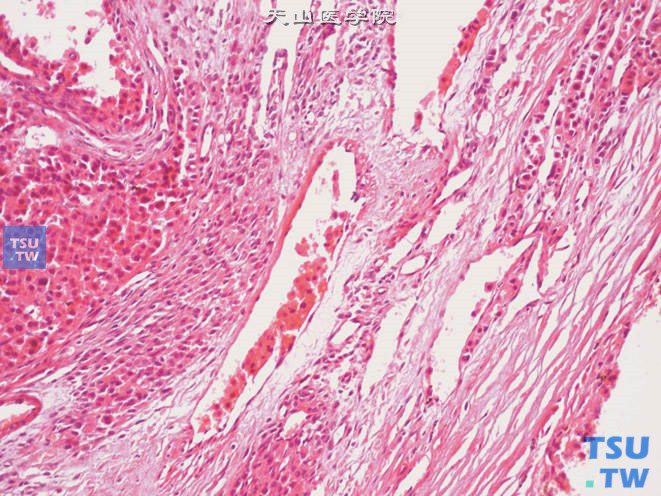睾丸恶性间质细胞瘤，可见血管浸润