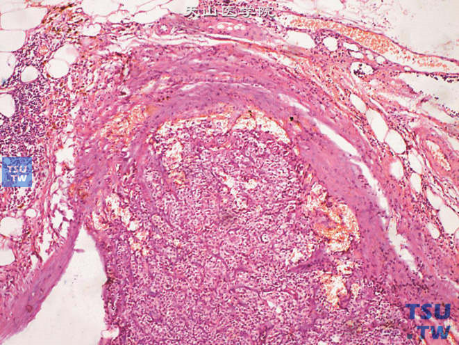 睾丸恶性间质细胞瘤腹股沟淋巴结转移。原发肿瘤细胞异型性不明显，但可见坏死及血管浸润