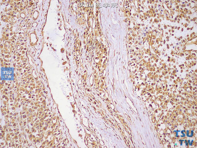 睾丸恶性间质细胞瘤，免疫组化：VIM（+）