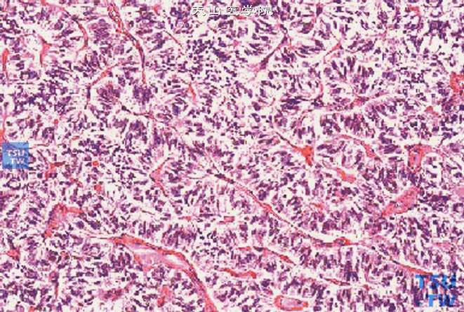 睾丸支持细胞瘤。瘤细胞排列成实性巢或索