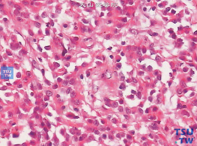 睾丸恶性支持细胞瘤，细胞有明显的异型性，可见核分裂象