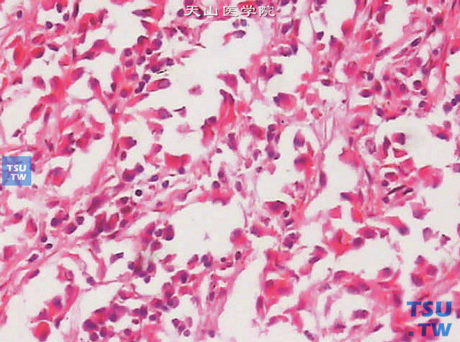 睾丸恶性支持细胞瘤，细胞异型性明显