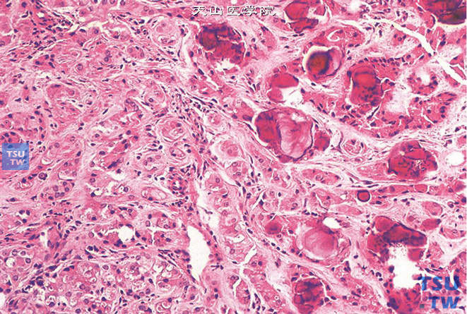 睾丸大细胞钙化性恶性支持细胞瘤，可见砂粒体