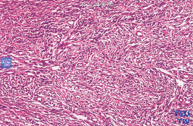 未分化性性索间质肿瘤，肿瘤可同时呈上皮性和间叶性分化，周围有性索样细胞簇。本例间叶成分较显著，呈肉瘤样表现
