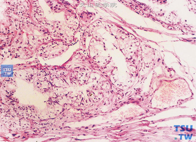  睾丸网腺癌，肿瘤位于睾丸网内，呈腺管状结构