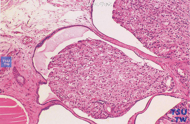  睾丸网腺癌，肿瘤位于睾丸网内，呈实体性结构