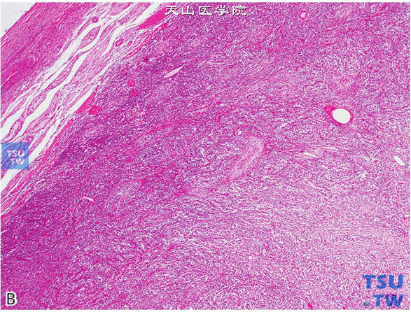 B.睾丸淋巴瘤，瘤细胞弥漫分布；