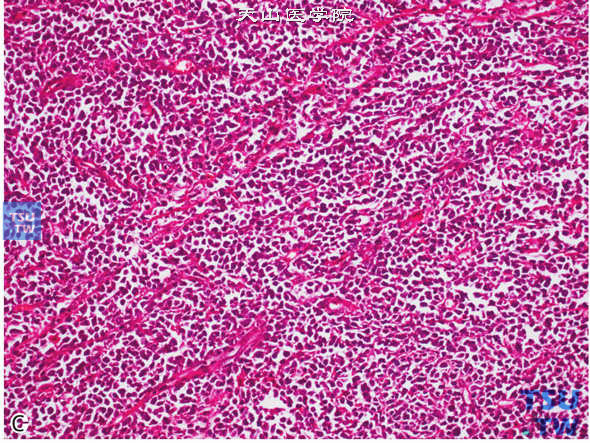 C.睾丸淋巴瘤，瘤细胞弥漫分布（上图高倍）；