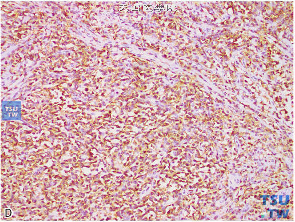 D.睾丸淋巴瘤，免疫组化：LCA（+）；