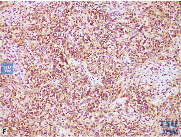 E.睾丸淋巴瘤，免疫组化：CD20（+）；