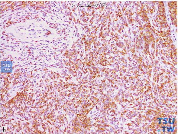 F.睾丸淋巴瘤，免疫组化：CD79a（+）