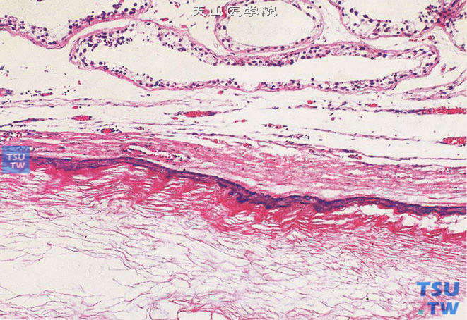 睾丸表皮样囊肿，囊壁为鳞状上皮，囊内为角化物质