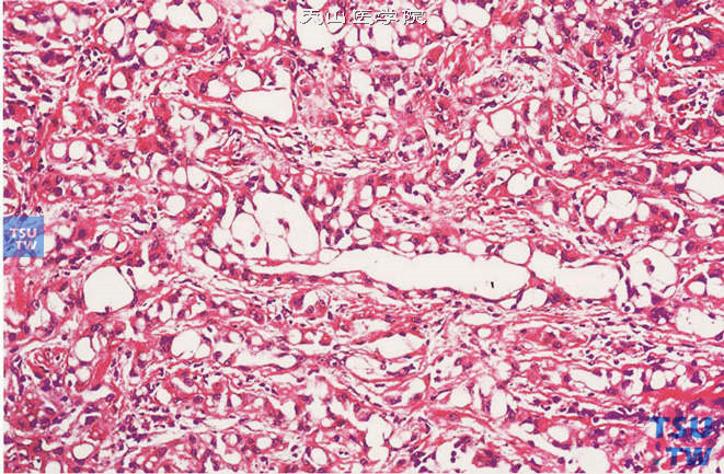 睾丸腺瘤样瘤。上图高倍，示肿瘤的不规则腔隙内衬间皮样细胞，胞质呈空泡状或嗜酸性细颗粒状。核圆形或卵圆形，染色浅