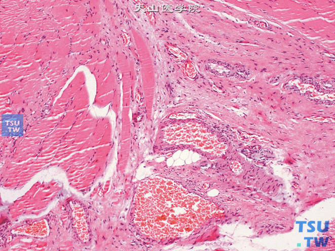 睾丸鞘膜积液的鞘膜组织，可见血管扩张、充血