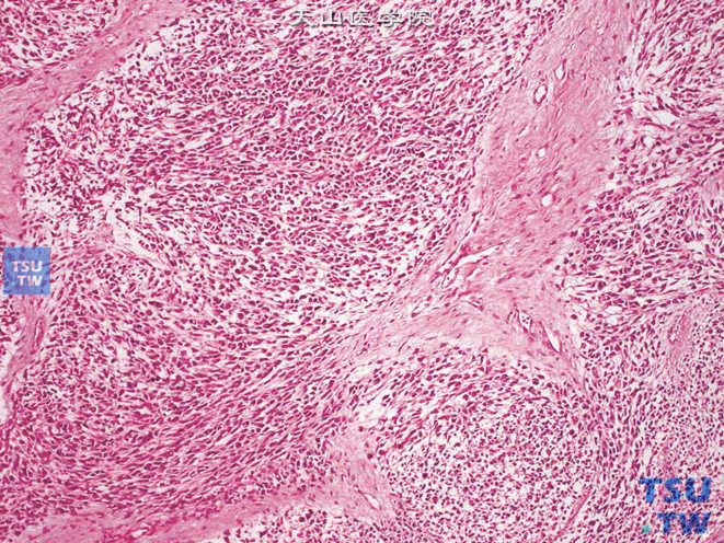 睾丸鞘膜梭形细胞胚胎性横纹肌肉瘤。示瘤细胞呈梭形，胞质嗜酸