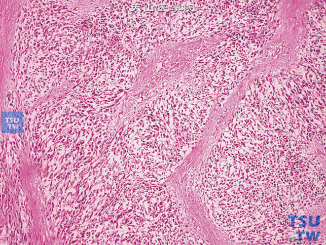 睾丸鞘膜梭形细胞胚胎性横纹肌肉瘤。梭形肿瘤细胞呈片状分布