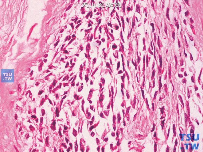 睾丸鞘膜梭形细胞胚胎性横纹肌肉瘤。示细胞核异型明显，核分裂象易见