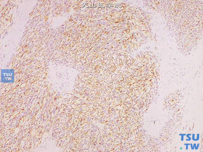 睾丸鞘膜梭形细胞胚胎性横纹肌肉瘤。免疫组化：DES（+）