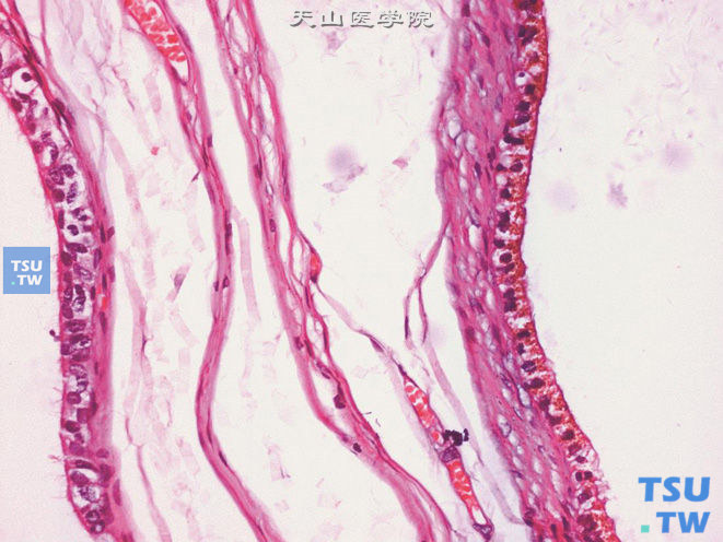 附睾附件，附件囊肿出血，示附件被覆上皮细胞内的含铁血黄素