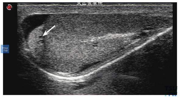 附睾正常结构超声图像特点：附睾分头体尾三部分，三部分很难在一个切面上完整显示，在睾丸的后上方的附睾头纵向扫查时，呈三角形或新月形，横切呈类圆形。内部回声与睾丸相等，附睾体及尾部体积很小，但仍可探查清楚，箭头指示为附睾头