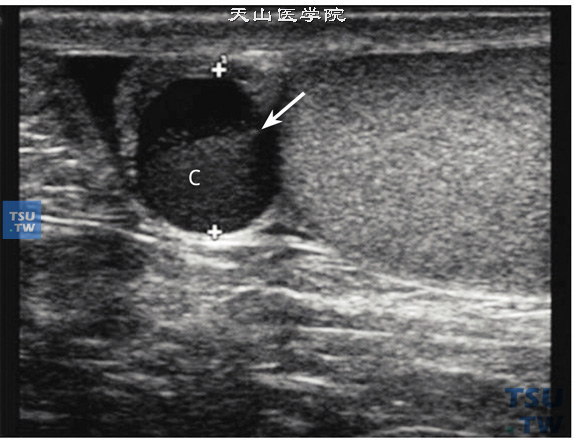 附睾头囊肿（精液囊肿）超声图像特点：典型的附睾头内或附睾头旁液性暗区，大多类圆形，表面光滑，因囊内含有精子成分，液性暗区内可含有细小光点（箭头指示）
