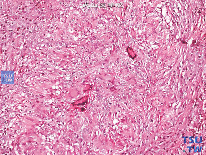 附睾精子肉芽肿，上图高倍，示多核巨细胞及精子碎片