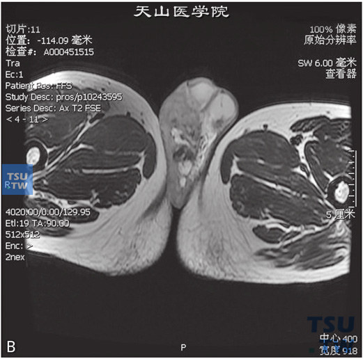 图B：CT，精索静脉曲张，男，48岁，阴囊坠胀感。右侧阴囊见纡曲管状T1WI稍高T2WI稍低信号灶，DWI未见异常信号