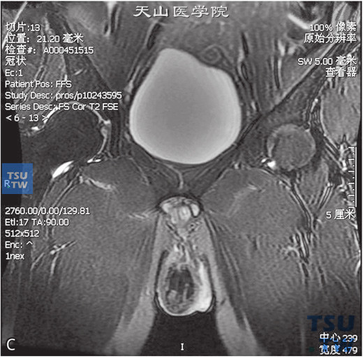 图C：CT，精索静脉曲张，男，48岁，阴囊坠胀感。右侧阴囊见纡曲管状T1WI稍高T2WI稍低信号灶，DWI未见异常信号