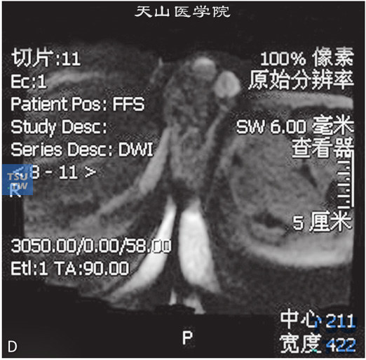 图D：CT，精索静脉曲张，男，48岁，阴囊坠胀感。右侧阴囊见纡曲管状T1WI稍高T2WI稍低信号灶，DWI未见异常信号