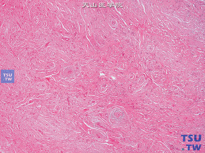 精索纤维性假瘤，纤维组织呈旋涡状排列