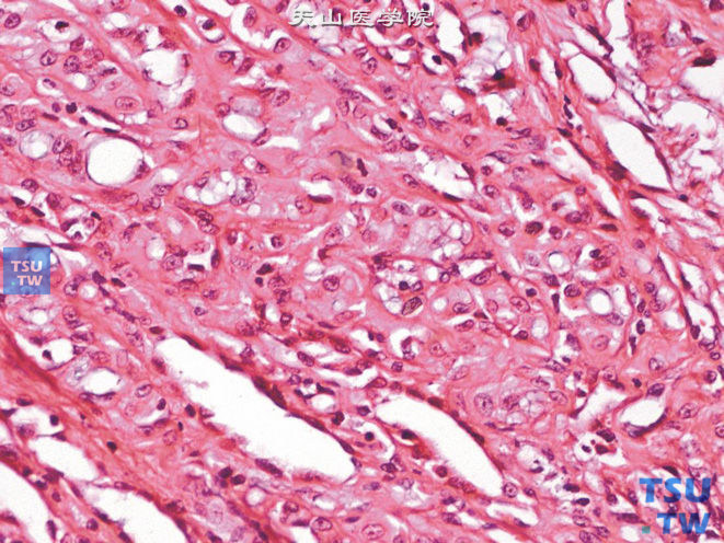 附睾腺瘤样瘤，示泡状胞质