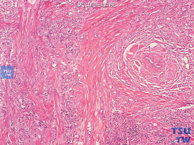 附睾腺瘤样瘤，间质中大量的平滑肌成分