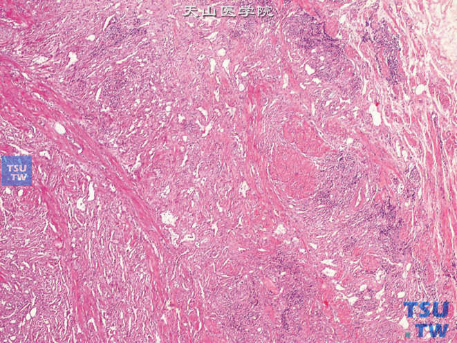 附睾腺瘤样瘤，间质可见纤维化、平滑肌成分及炎细胞浸润