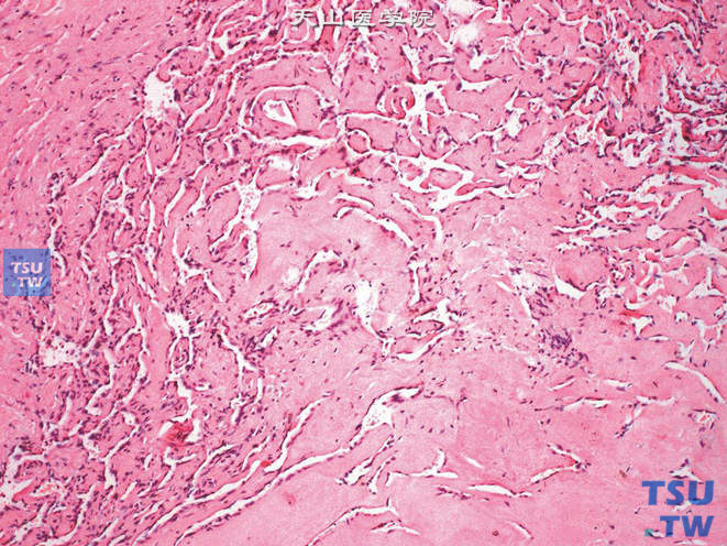 附睾硬化性血管瘤，管腔相互融合，间隔胶原化